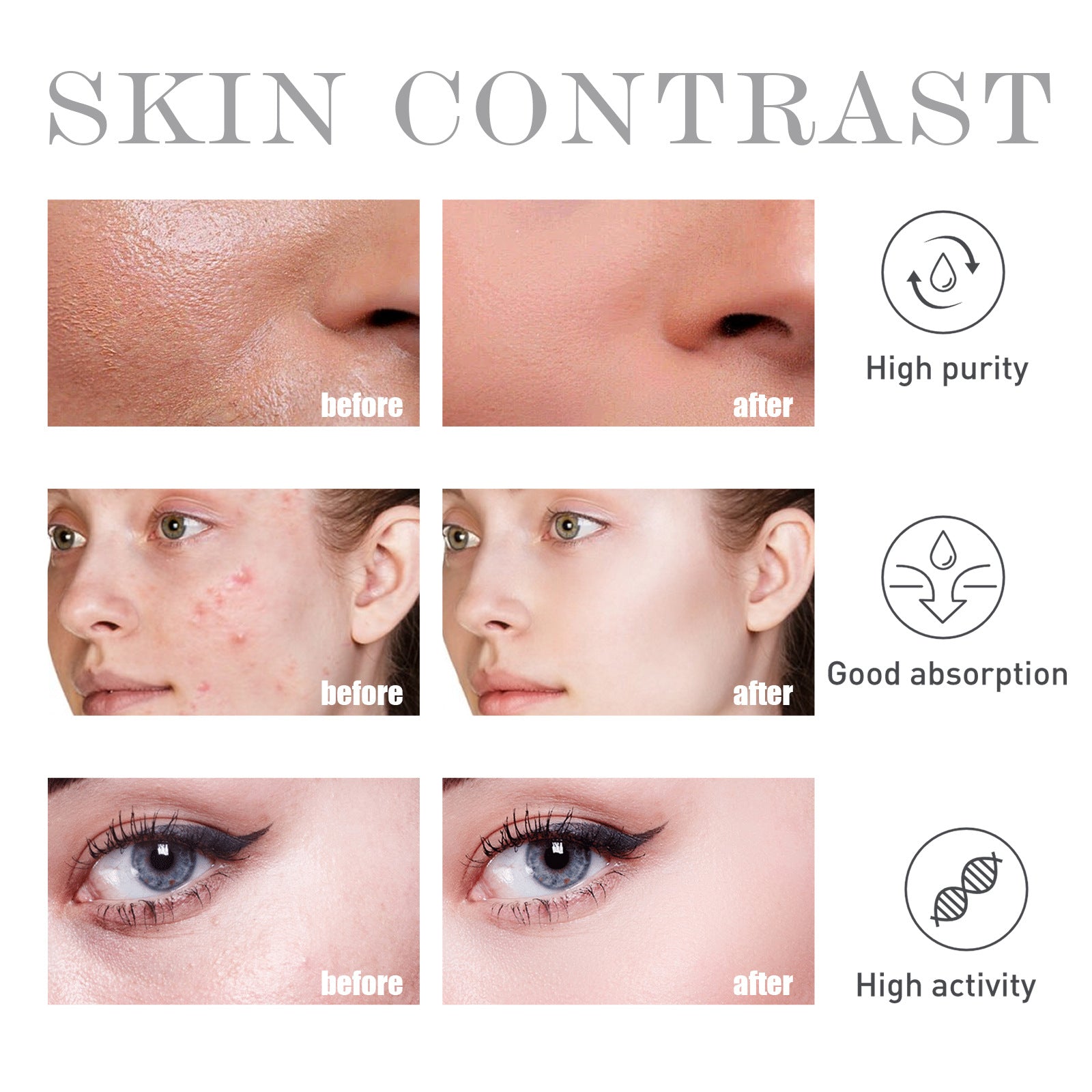 Salicylate Acne Treatment Cream - Skin Repair & Care for Clear Complexion | Perfect for Daily Skincare Routine & Blemish Control