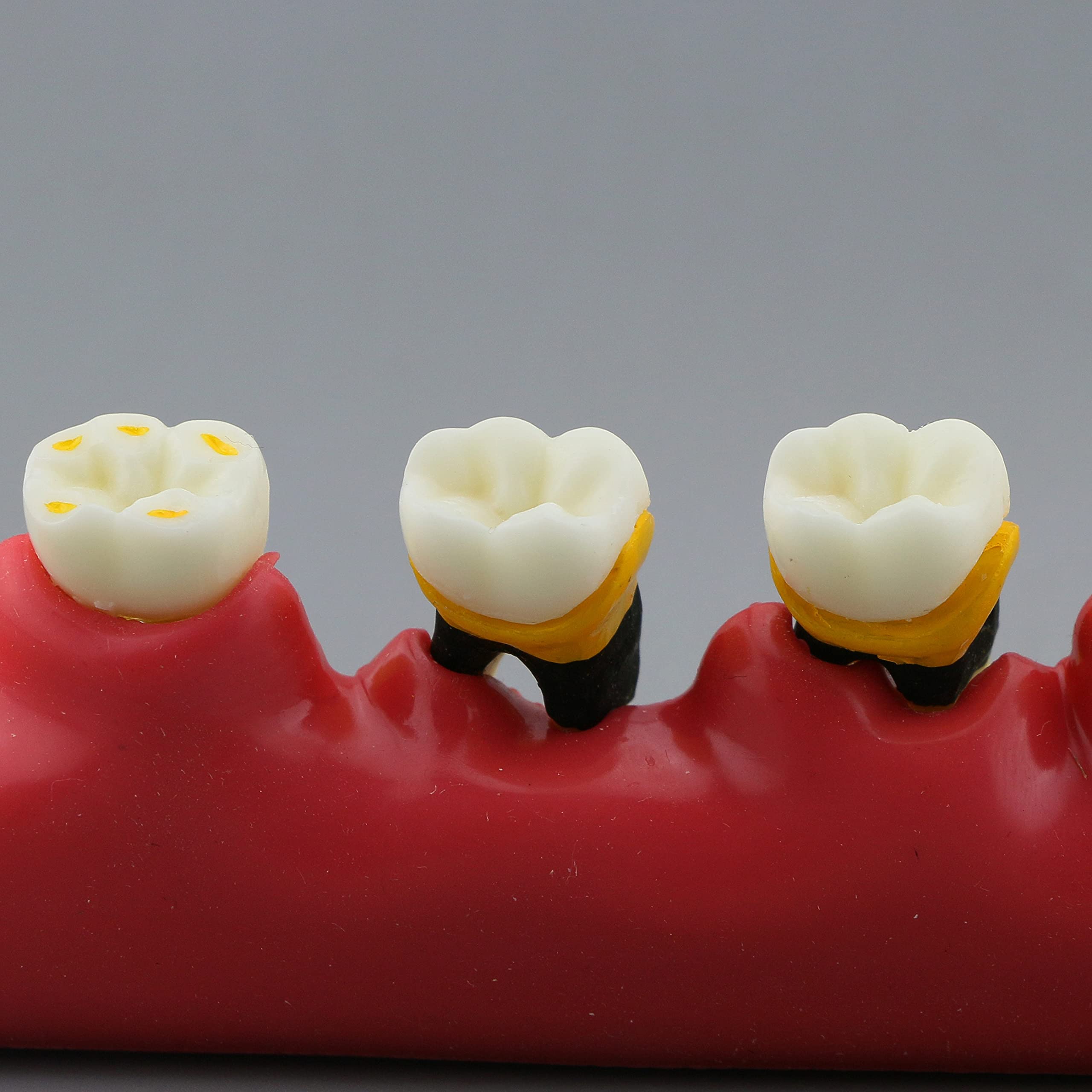 Dental Typodont Teeth Model for Adults & Children - Pathological Demonstration for Teaching & Studying (M4010) | Ideal for Dental Schools, Training & Clinical Practice