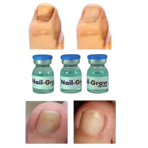 Fungal Nail Repair Serum & Care Kit - Effective Treatment for Toenail & Fingernail Fungus - Strengthens & Restores Damaged Nails - Perfect for Home Nail Care & Fungal Infection Prevention