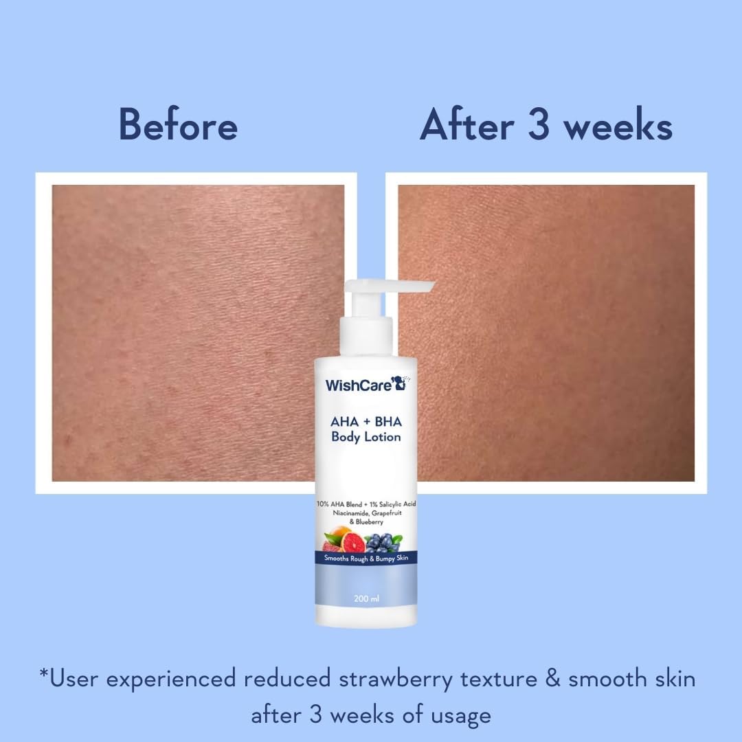 Wish.Care 10% AHA + 1% BHA Exfoliating Body Lotion - Glycolic & Lactic Acid Treatment for Rough, Bumpy Skin - Niacinamide Moisturizer - 200ml - Perfect for Dry Skin & Keratosis Pilaris Care