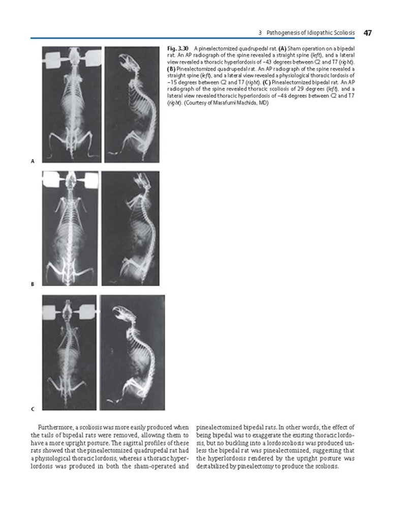 Idiopathic Scoliosis Treatment Guide - Harms Study Group Recommendations for Spinal Correction & Pain Relief | For Doctors, Physical Therapists & Patients