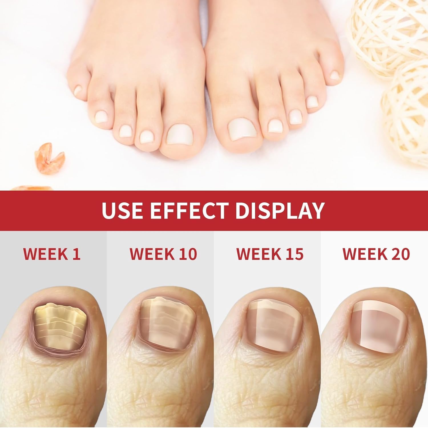 Extra Strength Toenail Fungus Treatment - Fast Acting Antifungal Solution for Toenails & Fingernails | 30ML (1 FLOZ) | Effective Remedy for Athlete's Foot & Nail Discoloration