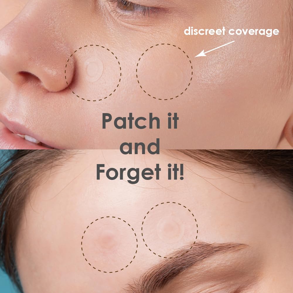 Magic Patch - Hydrocolloid Acne Pimple Patches for Zits & Blemishes | 38 Count Spot Stickers for Face & Skin Care | Korean Beauty (K-Beauty) | Perfect for Overnight Treatment & Daily Acne Relief