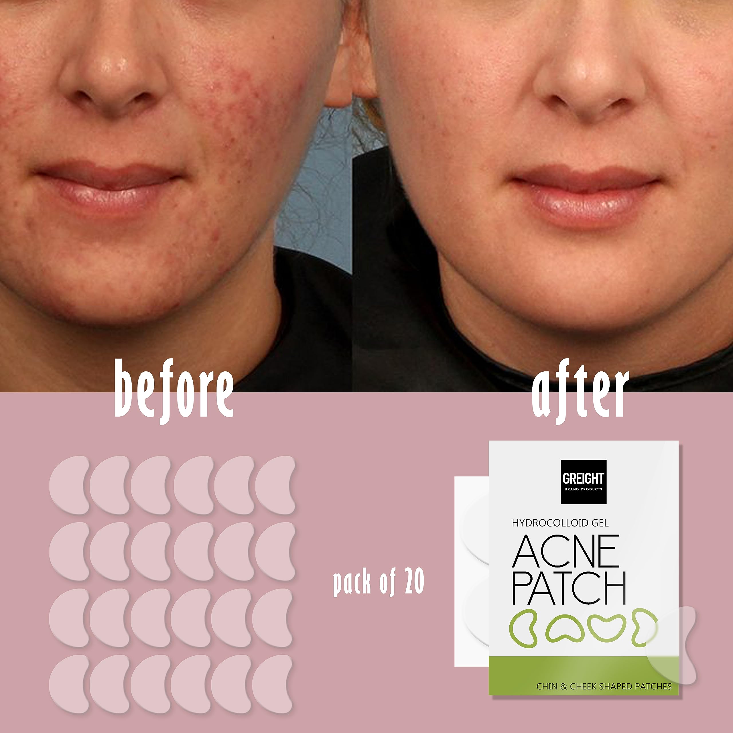 Hydrocolloid Acne Patches for Face - Vegan & Cruelty-Free Pimple Patches (20 Count) - Carbonfree Blemish Cover for Zits, Breakouts & Acne - Perfect for Overnight Spot Treatment & Daily Skincare Routine