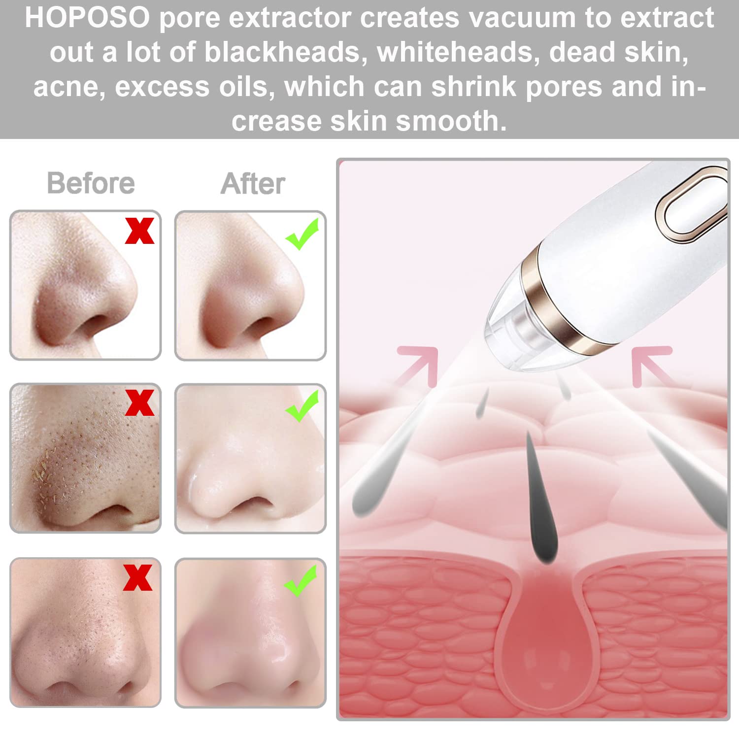 HOPOSO Electric Blackhead Remover Vacuum - Upgraded Pore Cleaner for Nose & Face, Acne Comedone Whitehead Extractor Tool - Perfect for Daily Skincare & Spa Treatments