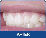 INSTANT WHITE SMILES 36% Teeth Whitening Gel - Professional Deep Stain Removal with 2x10ml Syringes & 2 Remineralizing Trays | At-Home Whitening Kit for Coffee, Wine & Smoking Stains