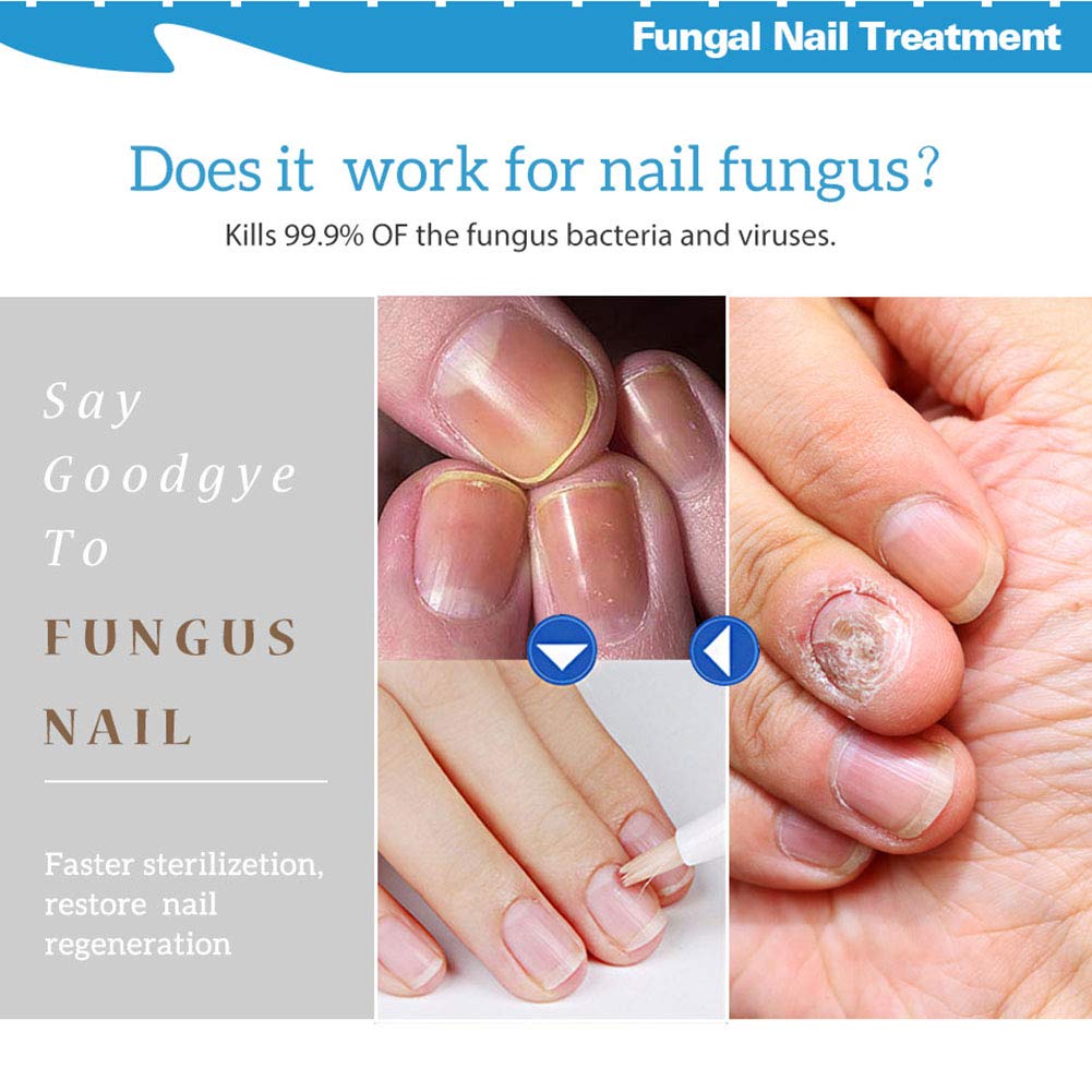 Ofanyia Anti-Fungal Nail Treatment Pen for Toenail & Fingernail Fungus Repair - Strengthens Brittle Nails & Promotes Healthy Growth - Effective Nail Care Solution for Athletes, Swimmers & Daily Use