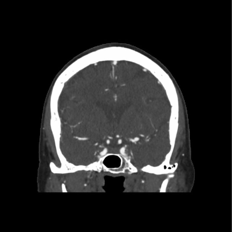 CTA Aneurysm Head Phantom for CT Scan and X-Ray Training - High-Quality Medical Simulation Tool for Radiology Education and Diagnostic Practice