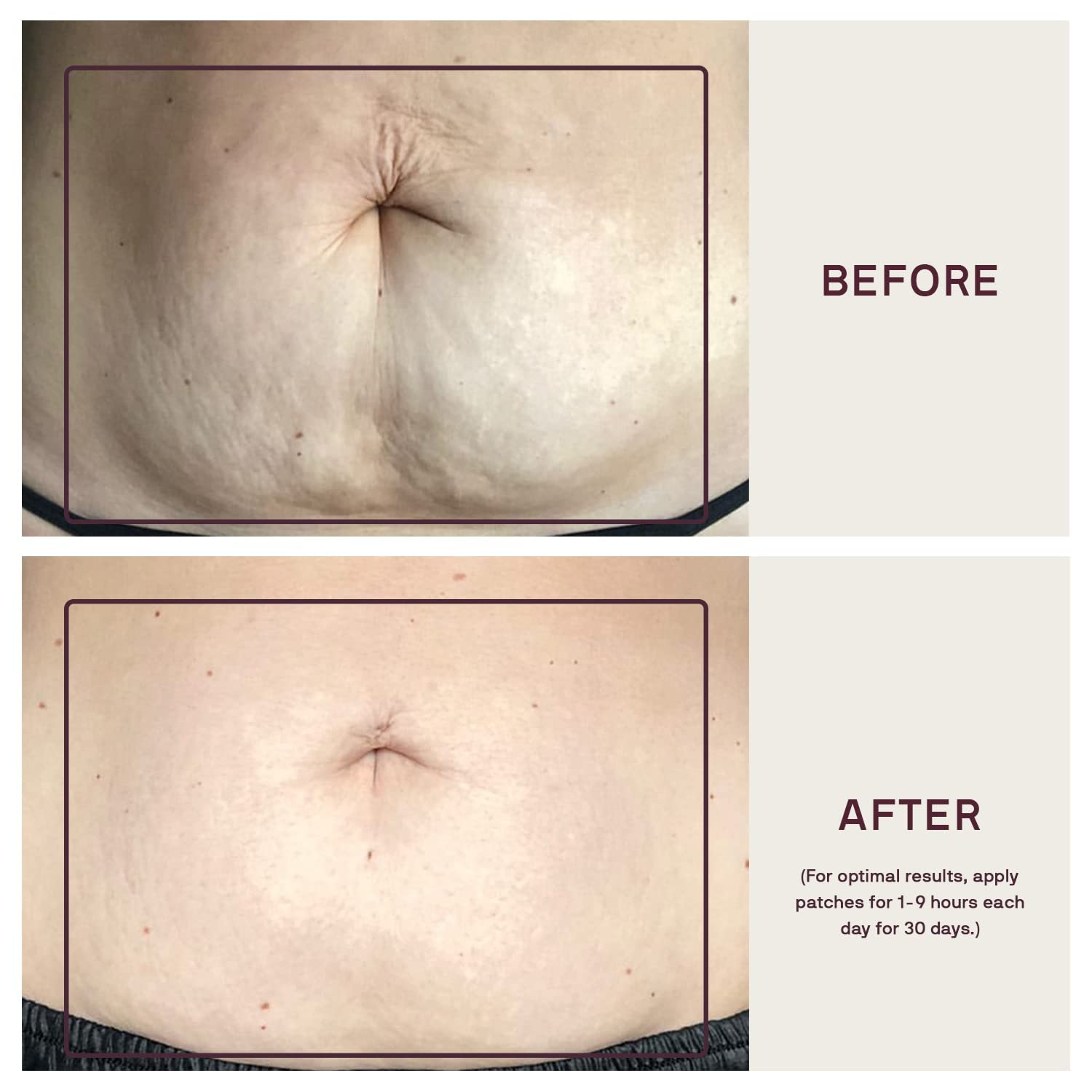 Dermaclara Large Body Patch for Pregnancy Stretch Marks - Silicone Gel Sheets for C-Section Scar Cover & Belly Scar Removal, Reusable Maternity Skincare (2 Patches + Cleanser) - Perfect for Postpartum Recovery & Smooth Skin Care