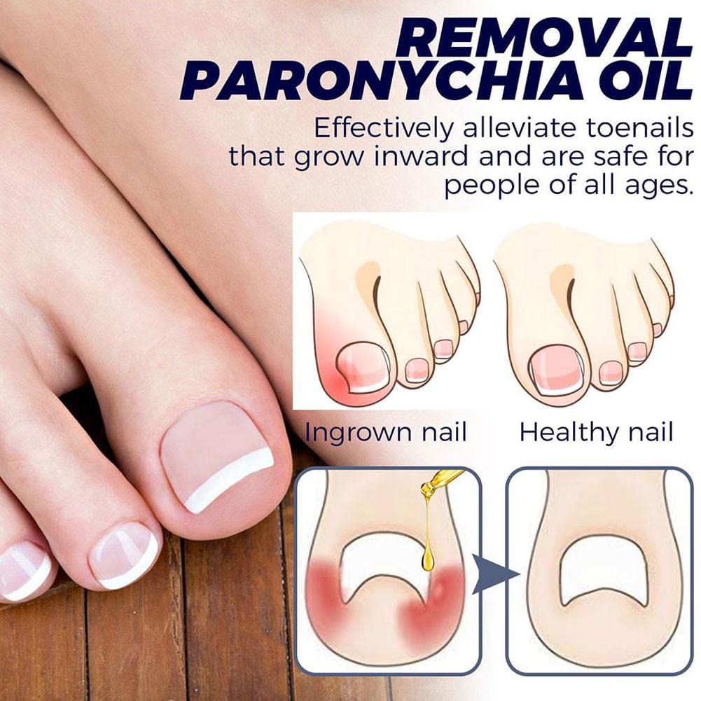 Toenail Care Removal Oil - Paronychia & Ingrown Toenail Treatment | Nail Renewal Liquid for Damaged & Discolored Nails | Fast Healing Solution for Healthy Feet | Perfect for Pedicures & Daily Foot Care