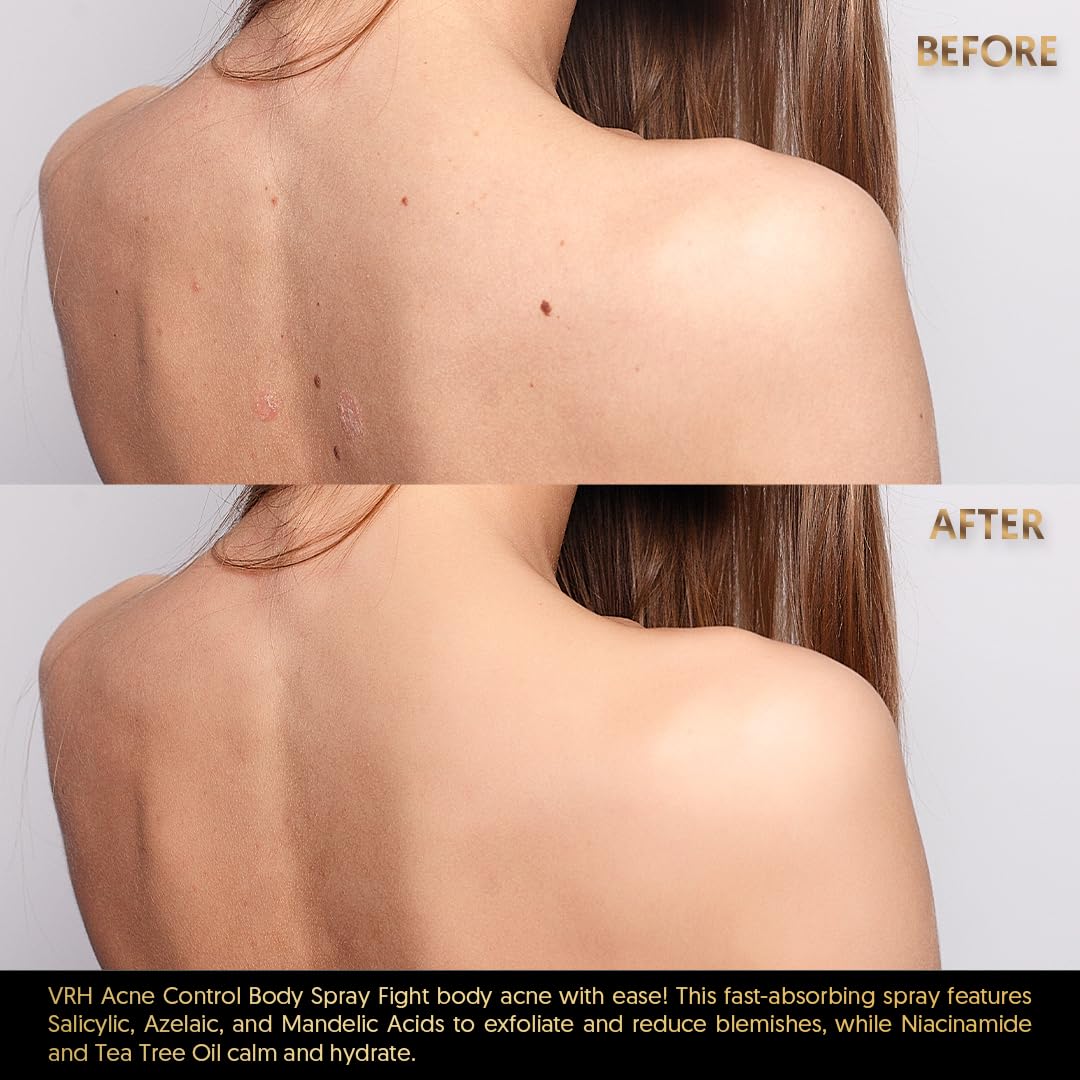 VRH Acne Control Body Spray - Triple Acid Blend (Salicylic, Azelaic & Mandelic Acids) with Niacinamide & Tea Tree Oil | Zinc Oxide Protection | Soothes Skin with Seaweed & Tazetta Bulb | Clarifying Treatment for Clearer Skin at All Ages | 50ml | Perfect for Post-Workout, Travel & Daily Skincare Routine