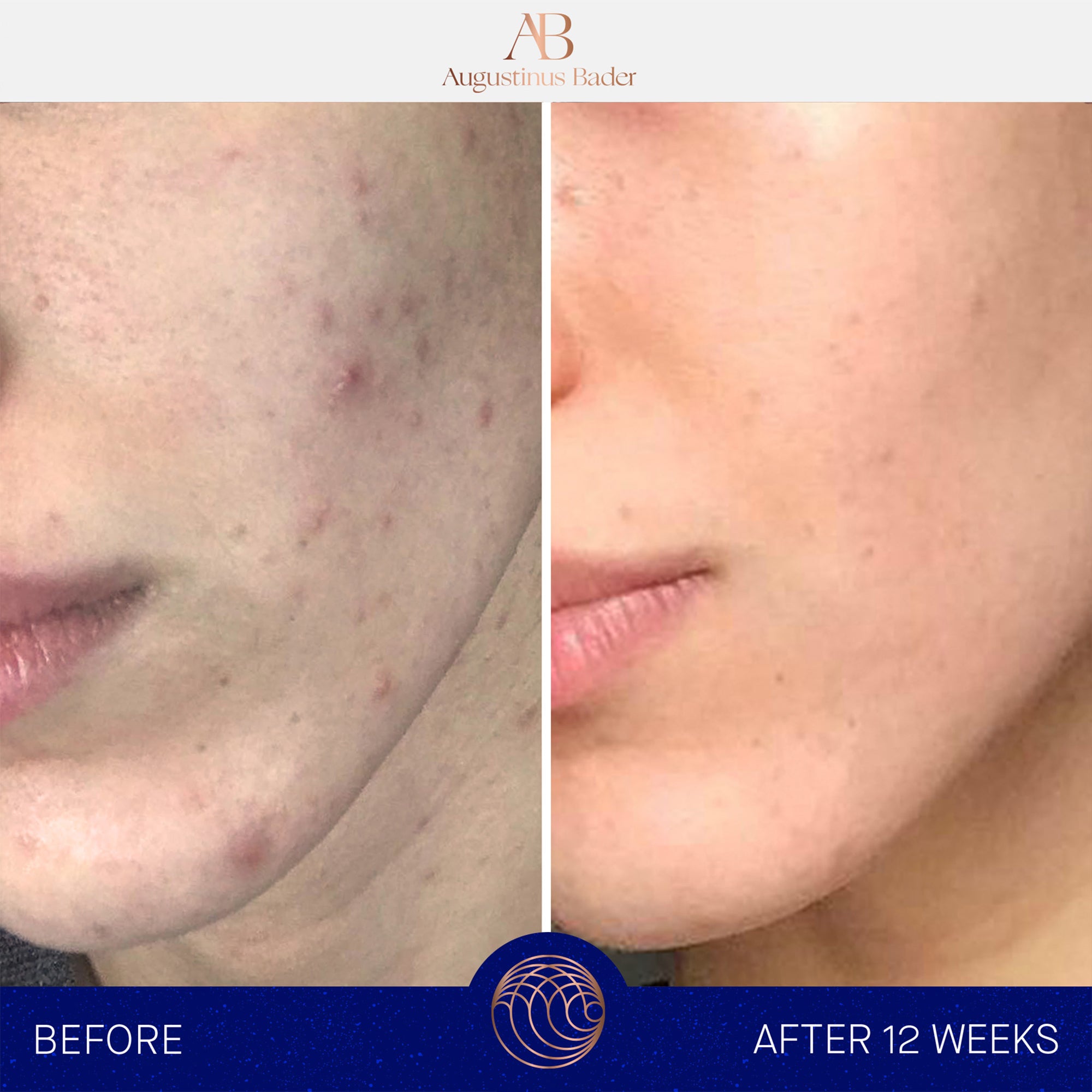 Augustinus Bader The Cream | Rich Moisturizing Face Cream for Dry Skin | Anti-Aging & Hydrating Skincare | Perfect for Night Routine & Daily Use