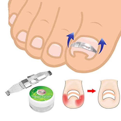 Yosoo Health Gear Stainless Steel Ingrown Toenail Corrector - Paronychia Treatment Tool & Nail Care Patch for Pain Relief | Perfect for Home Pedicure, Toenail Correction & Foot Care Routine