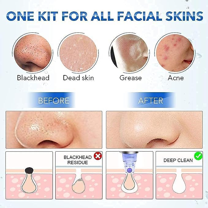 NOBILEA Derma Suction Vacuum Skin Cleanser - 4-in-1 Blackhead & Pimple Remover Tool for Deep Pore Cleansing | Acne Treatment & Facial Exfoliation Kit | Perfect for Daily Skincare, Spa & At-Home Beauty Routine