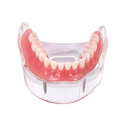 Dental Implant Demonstration Teeth Model - M6002 for Dental Teaching, Practice & Training | Perfect for Dentists, Students & Dental Clinics