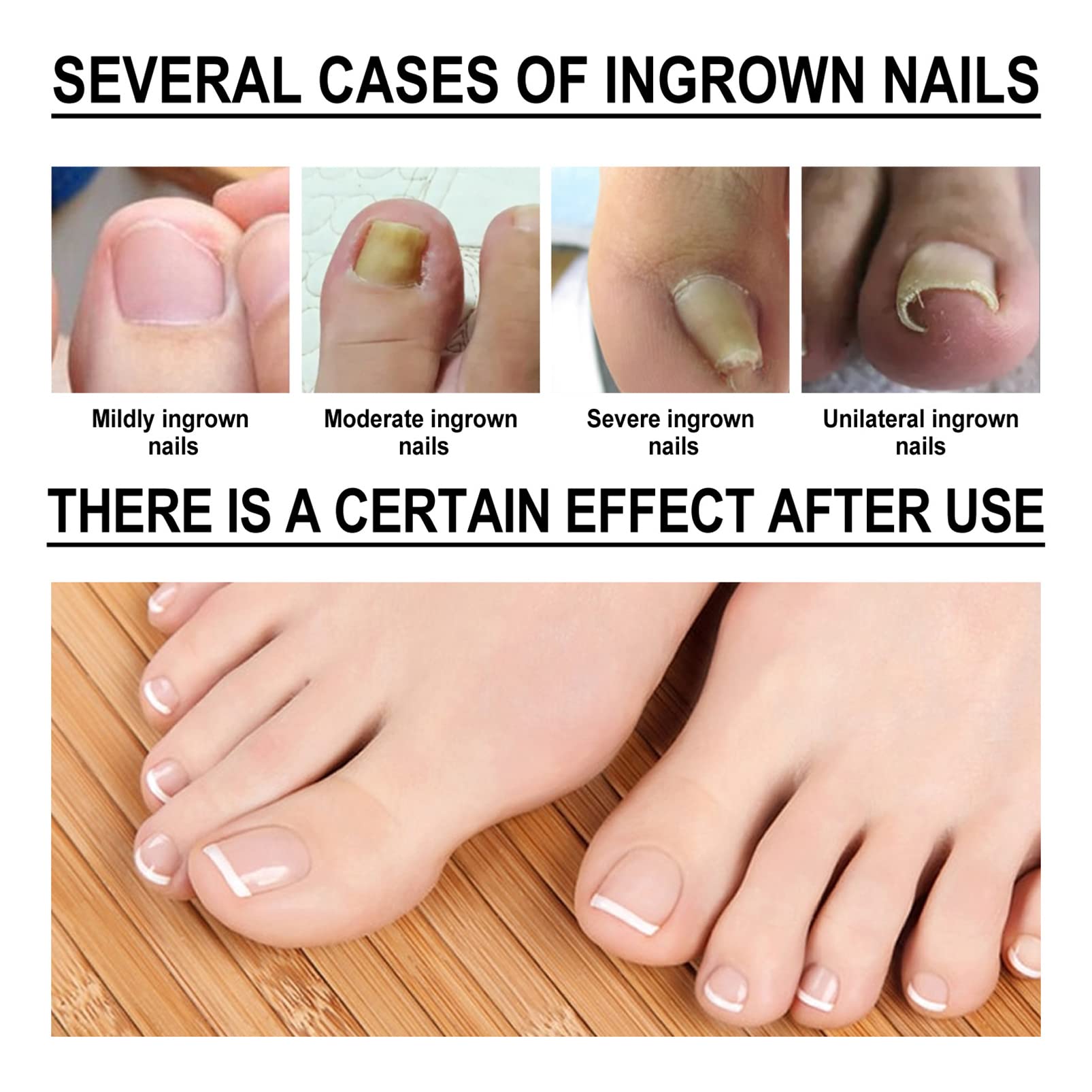 Best Ingrown Toenail Treatment Drops - Fast Relief for Painful Ingrown & Fungal Nails - Cuticle Care & Nail Softening Oil - Perfect for Pedicures, Athletes & Daily Foot Care