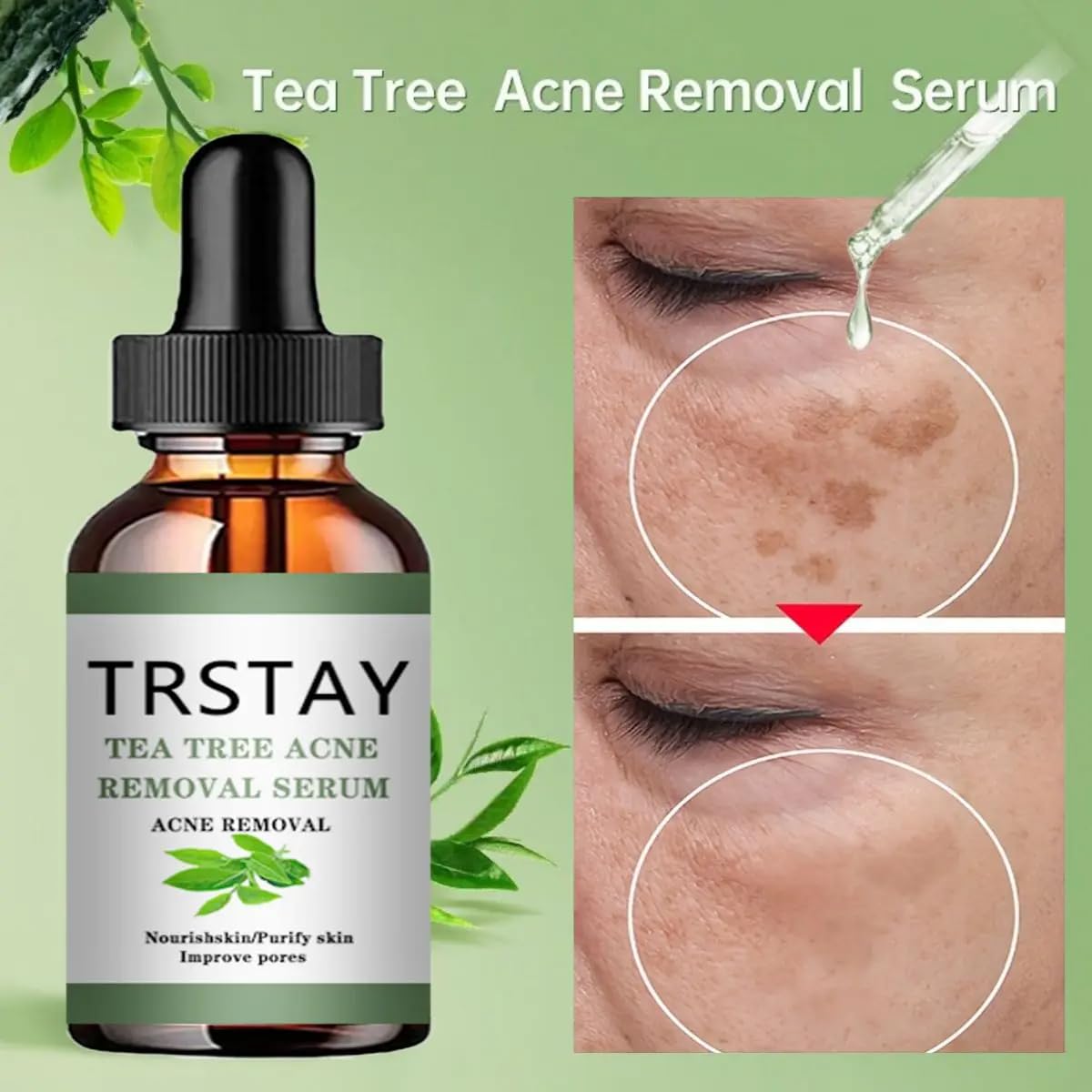Tea Tree Oil Acne Treatment Face Serum - Korean Skin Care for Moisturizing, Pore Minimizing & Acne Relief | Perfect for Oily, Acne-Prone Skin & Daily Skincare Routine