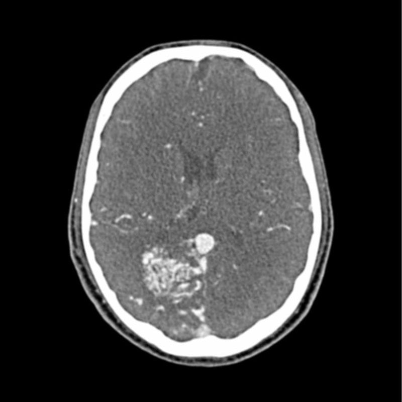 Head and Neck CTA Phantom AVM for CT Scan & X-Ray Training - Medical Imaging Practice, Radiology Education, and Diagnostic Testing