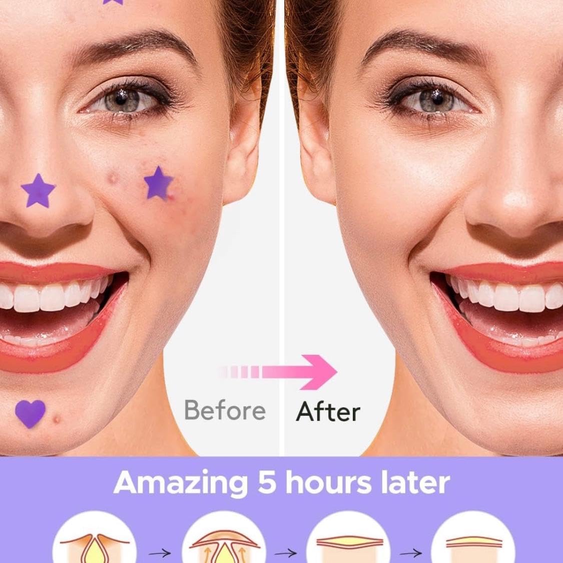 HappyFace 180 Count Hydrocolloid Acne Pimple Patches - Combo Stars & Hearts Blemish Spot Dots (2 Sizes, 5 Sheets) for Face Care & Overnight Treatment - Perfect for Teens, Adults & Sensitive Skin