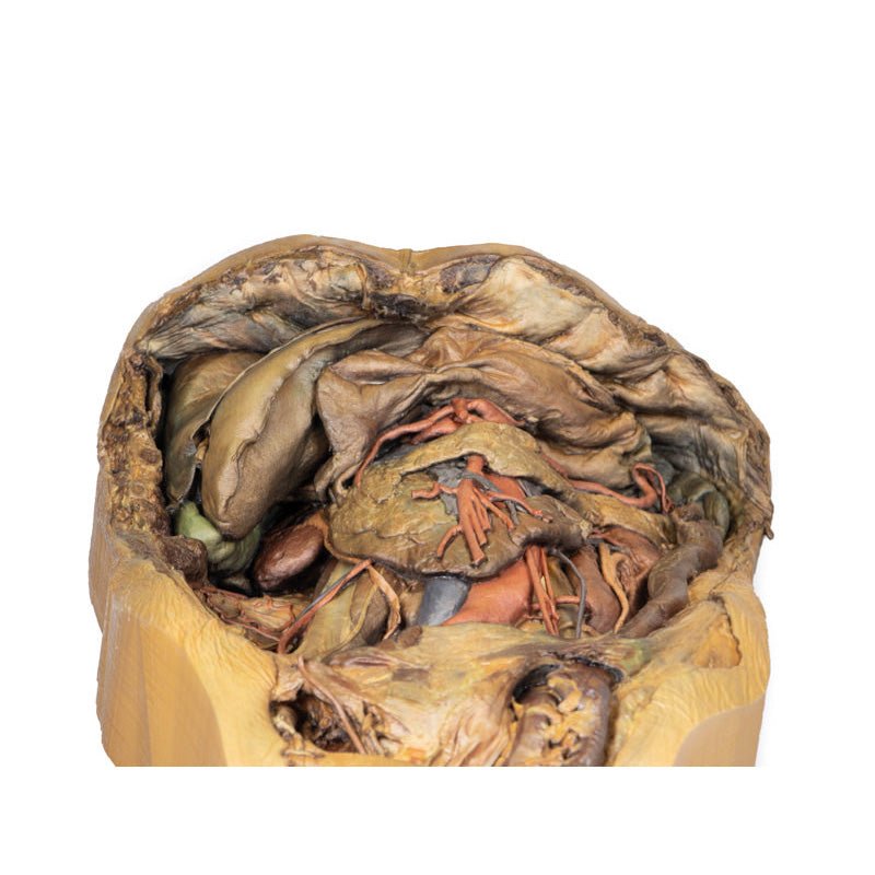 3D Printed Abdomen Model with Inguinal Hernia - Medical Training & Anatomy Study Tool for Students, Doctors & Surgeons