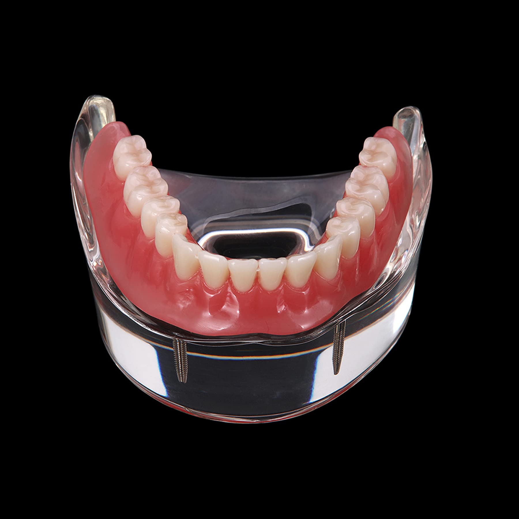 Premium Dental Implant Demo Model - M6002 Overdenture Restoration Kit with 2 Implants | Ideal for Dental Education, Training & Patient Demonstration