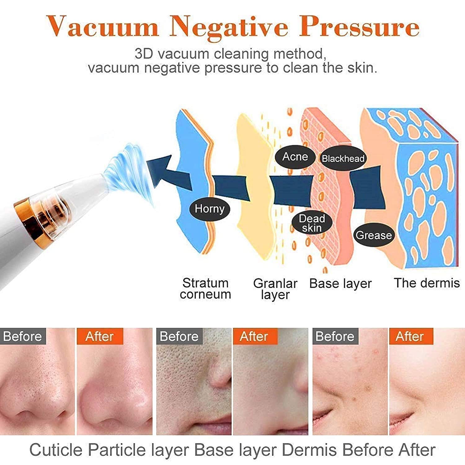 6-in-1 Blackhead Remover Vacuum - Pore Cleaner for Acne & Skin Care | Home Spa Device for Men & Women