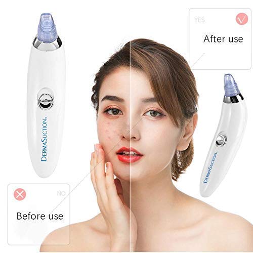 McMus Professional Acne Pore Cleaner & Blackhead Remover Kit - Facial Cleansing Vacuum Tool for Pimple & Acne Treatment - Skin Care Device for Men & Women - Perfect for Daily Deep Cleansing & Spa Skincare Routine