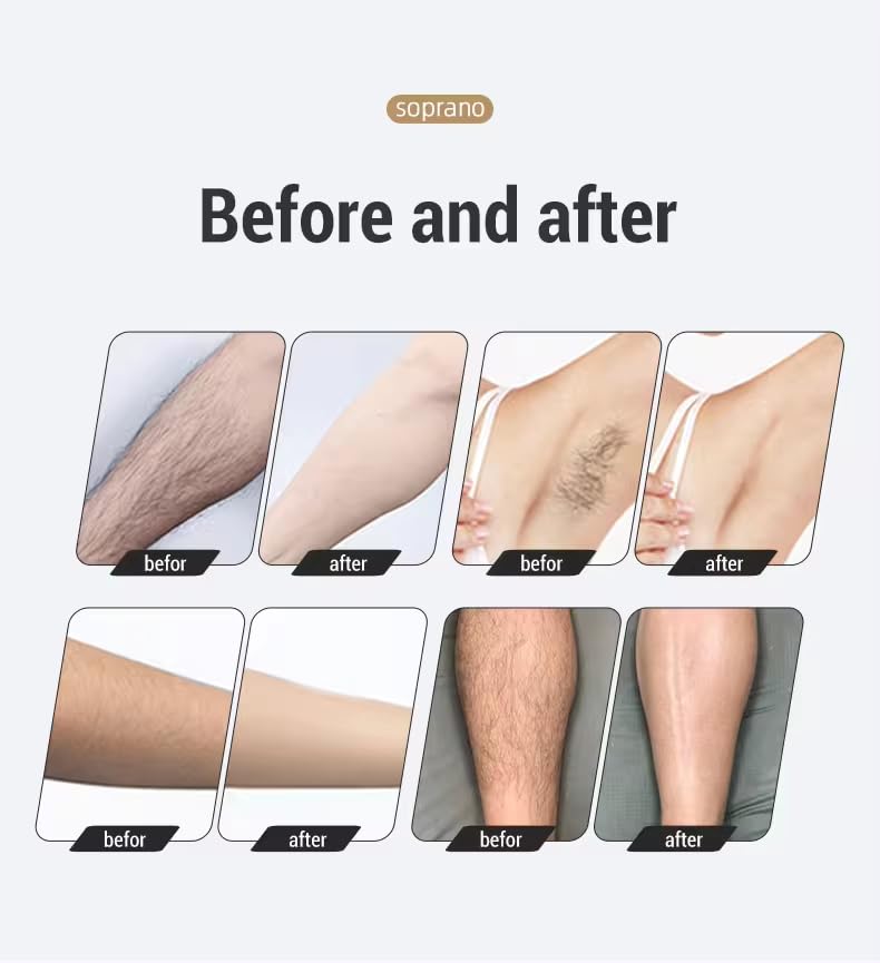 Professional Alma Soprano Ice 808nm Diode Laser Hair Removal Device - Painless & Effective At-Home Hair Removal for Women & Men - Perfect for Face, Legs, Bikini Line & Underarms