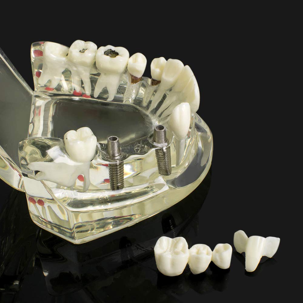 Dental Teeth Model - Transparent Implant Disease Removable Tooth Demonstration Kit for Dental Students & Professionals | Perfect for Classroom Teaching, Clinical Training & Patient Education