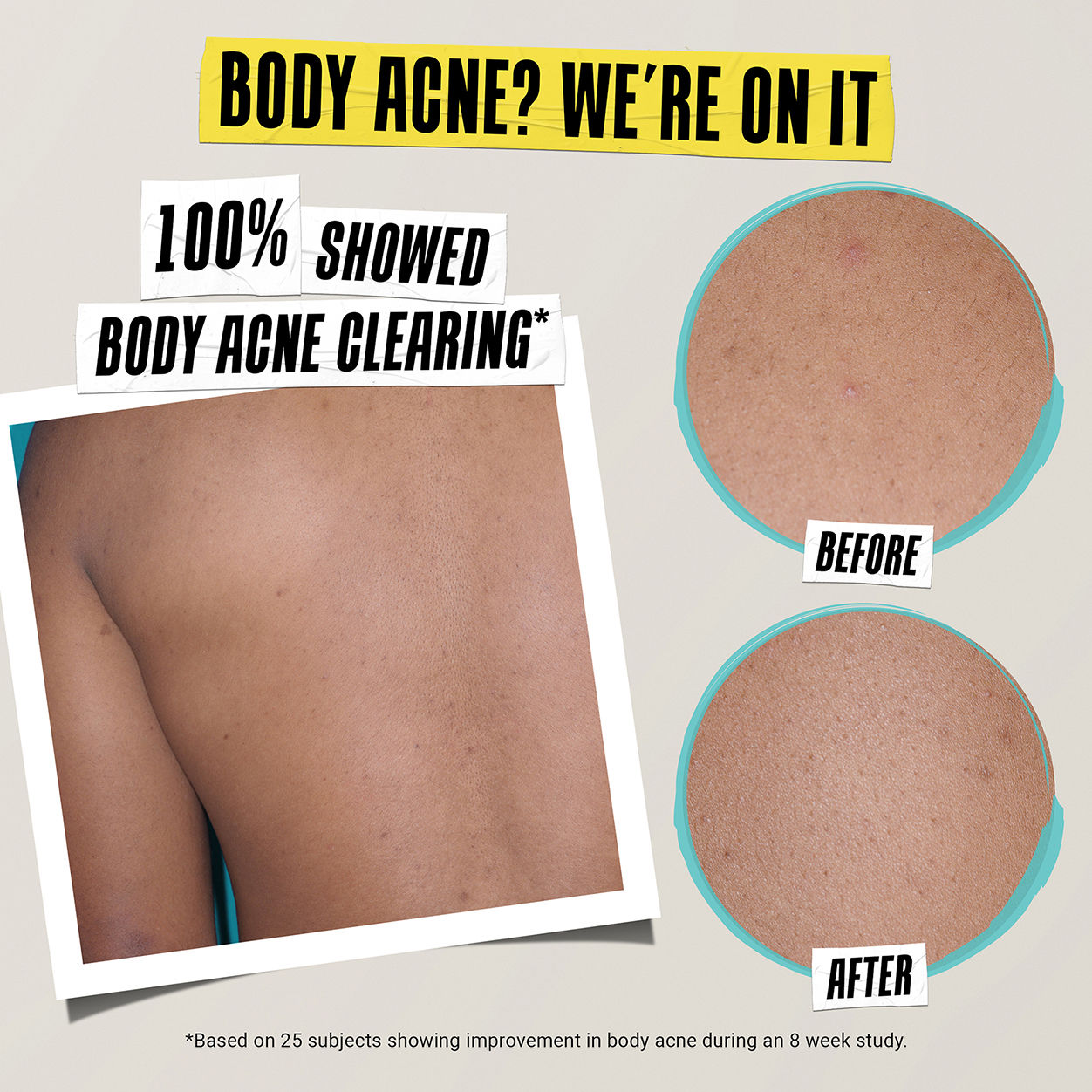 Best Acne Treatment Lotion for Clear Skin - Expert Formula to Prevent & Treat Breakouts | Perfect for Daily Skincare Routine & Oily Skin Care
