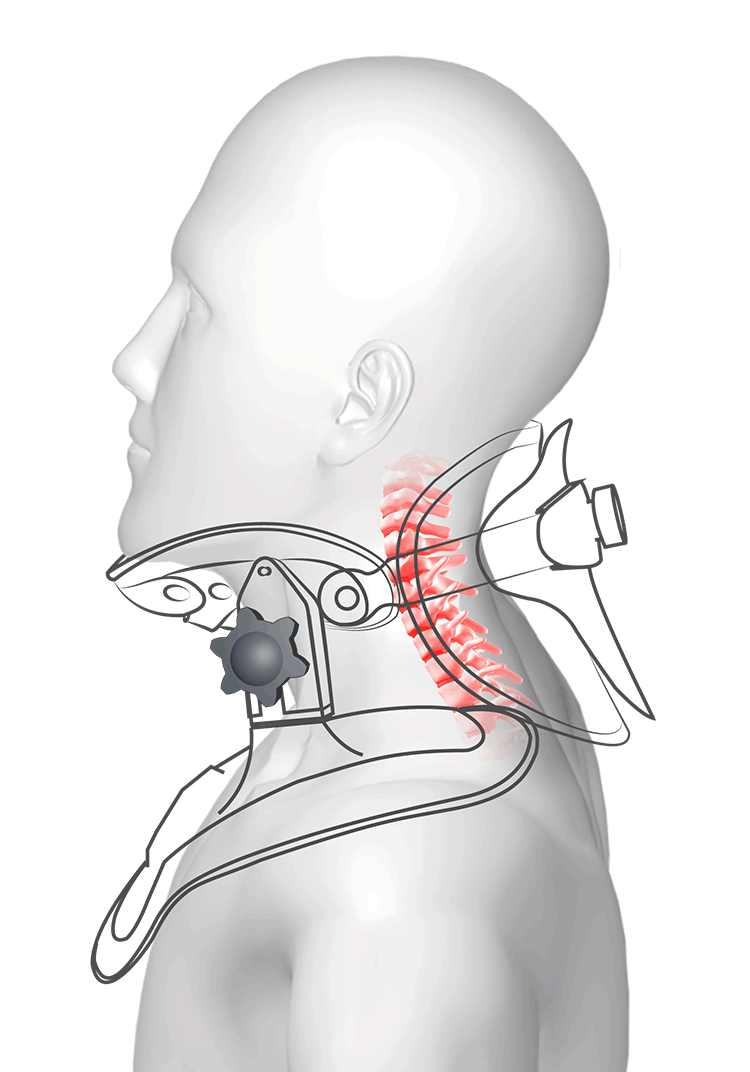 Siyaco CE 3000 Manual Cervical Neck Traction Device - Relieve Neck Pain & Improve Posture - Home Physical Therapy for Herniated Disc, Pinched Nerve & Whiplash Recovery