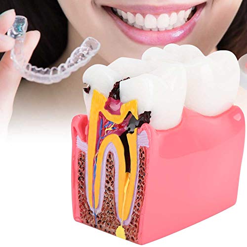 **ANGGREK Dental Caries Comparison Study Model - Teeth Anatomy Education Tool for Dentists & Students - Perfect for Dental Training, Patient Education & Classroom Demonstrations**