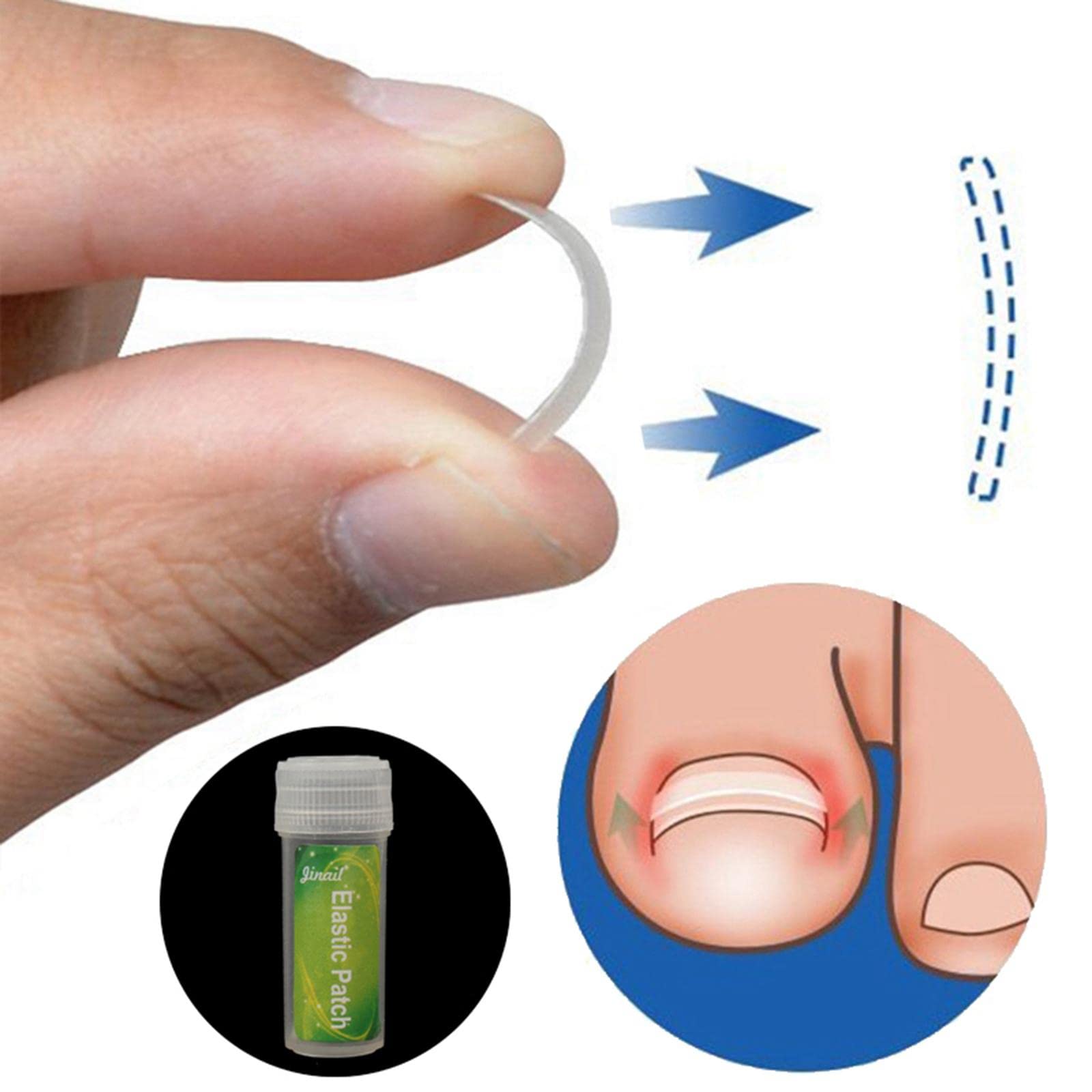 LOSA Ingrown Toenail Treatment - Professional Ingrown Toenail Correction Tool for Pain Relief & Pedicure Care | Perfect for Home Use, Salon Treatments & Foot Care Routines