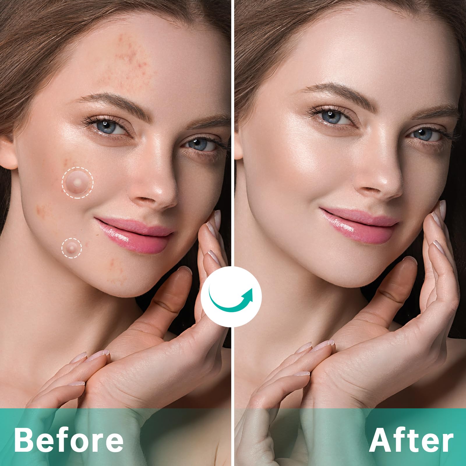 Hydrocolloid Acne Patches for Face - 210 Count Pimple Patches in 4 Sizes, Absorbs Fluid & Treats Zits, Blemishes & Breakouts | Perfect for Overnight Spot Treatment & Daily Acne Care