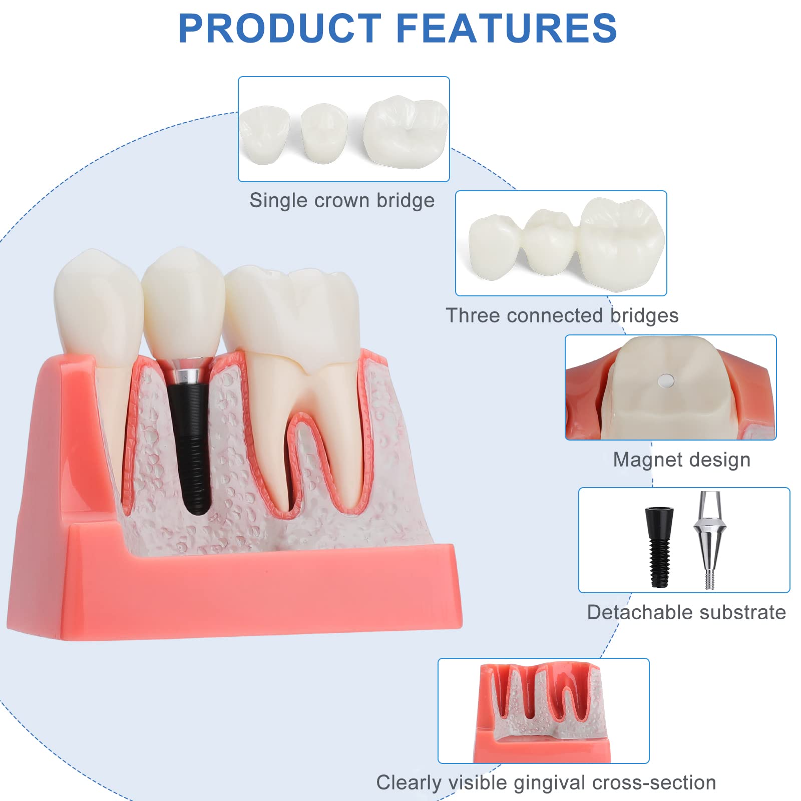 Dental Implant Model - 4X Removable Implant vs Bridge Demonstration Teeth for Dental Education & Practice | Perfect for Dental Students, Professionals & Training Clinics