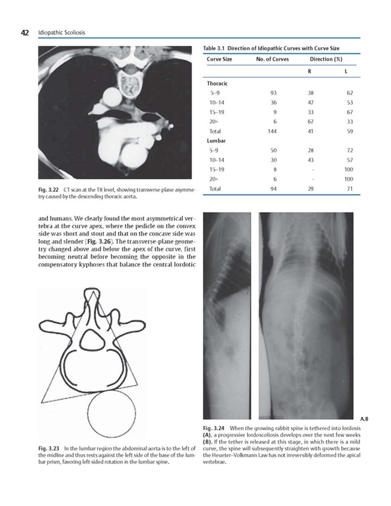 Idiopathic Scoliosis Treatment Guide - Harms Study Group Recommendations for Spinal Correction & Pain Relief | For Doctors, Physical Therapists & Patients
