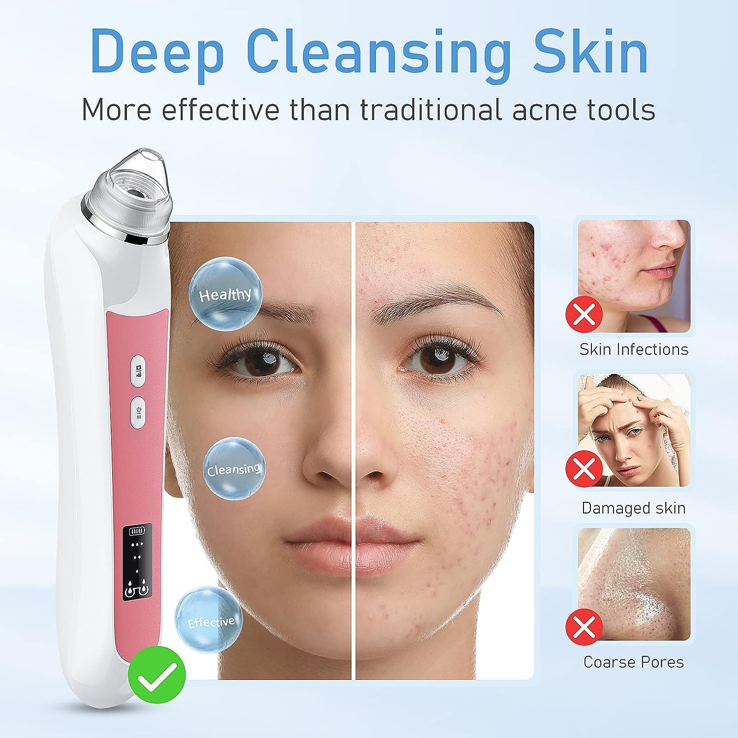 USB Blackhead Remover Vacuum with Camera - 3 Modes & 6 Heads for Deep Pore Cleaning at Home (Light Pink)