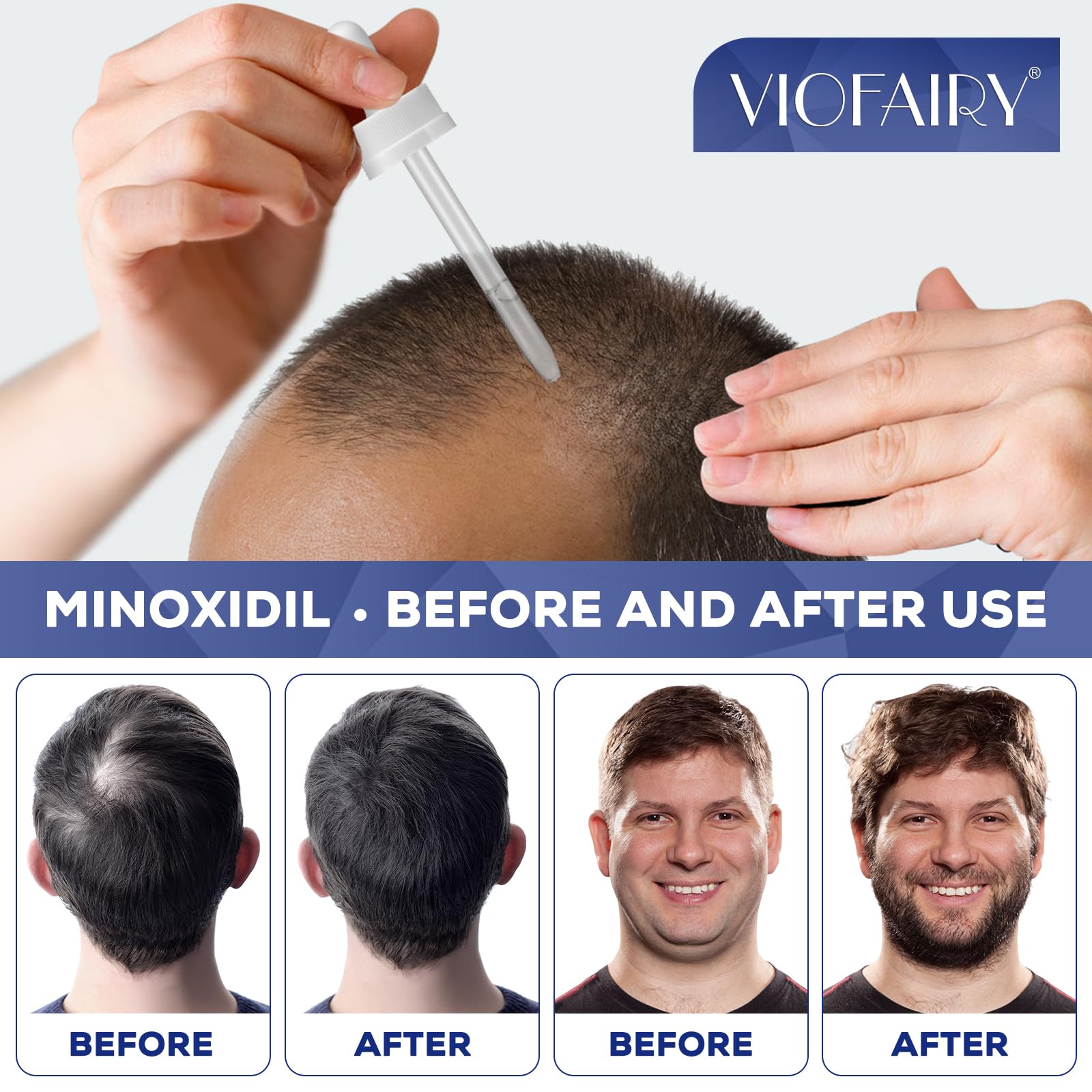 5% Minoxidil for Men & Women - Hair Growth & Beard Growth Treatment - Combat Thinning Hair & Hereditary Hair Loss - Effective for Hair Regrowth & Thicker Hair - Perfect for Daily Use at Home or Salon