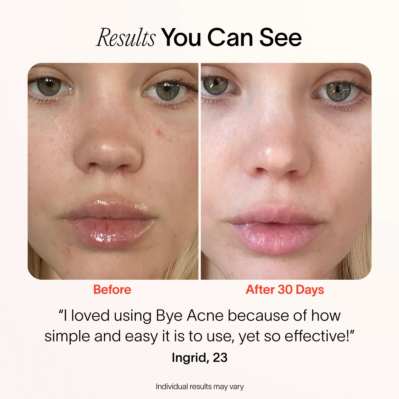 Bye Acne: Fast-Acting 3 Minute Pimple Spot Treatment for Clear Skin | Perfect for Overnight Use & On-The-Go Acne Care