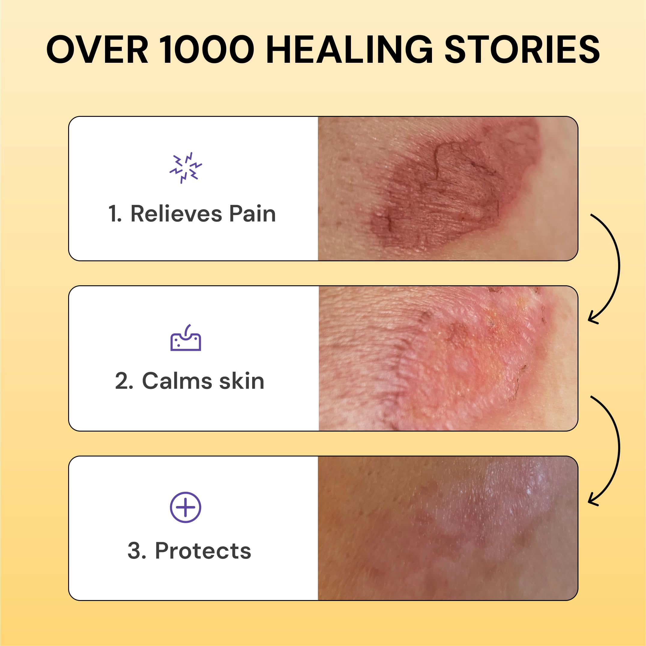 Universal Flare Care - Essential Oil Free Skin Relief for Eczema, Dermatitis, Psoriasis, Rashes & Baby Skin Issues | Propolis & Egg Yolk Formula | Soothes Hidradenitis, Chafing, Sores & Wounds | 1oz | Perfect for Daily Skincare & Sensitive Skin Care Routine