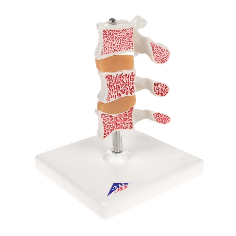Premium Osteoporosis Bone Model - Anatomically Accurate Skeletal Display for Medical Education & Patient Demonstration - Perfect for Classrooms, Clinics, and Healthcare Training