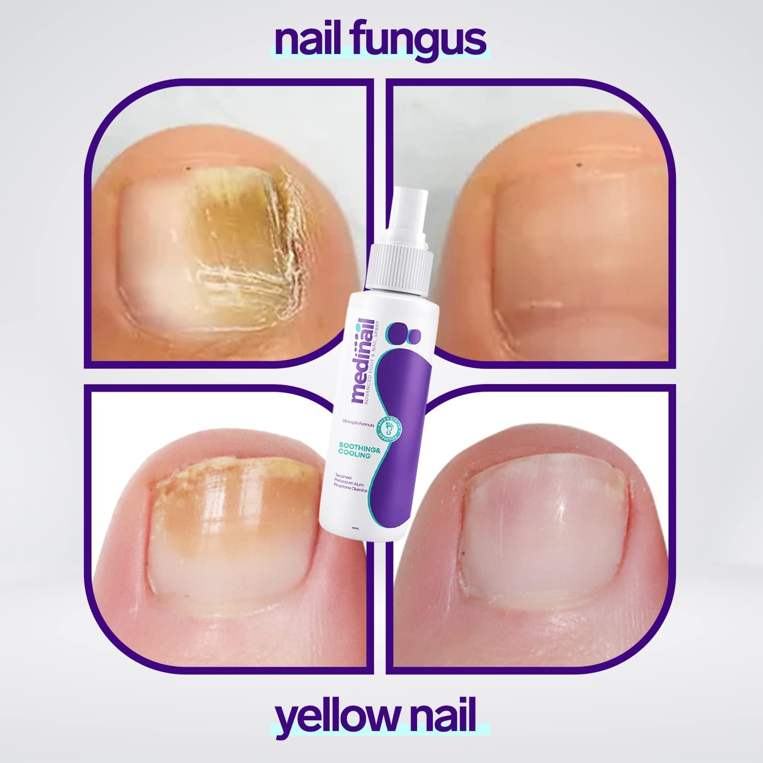 Medinail Advanced Nail Treatment Spray - Toenail & Hand Nail Repair, Strengthener for Fungus & Brittle Nails (10.14 Fl Oz, Pack of 3) - Ideal for Athletes, Pedicures & Daily Foot Care