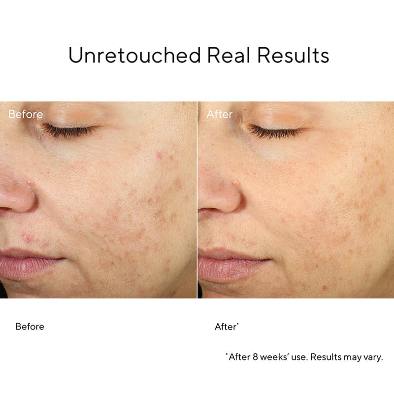 Murad Blemish Control InvisiScar Resurfacing Treatment for Acne Scars & Dark Spots - Skin Renewal Solution for Face & Body - Perfect for Post-Acne Care & Evening Skin Tone