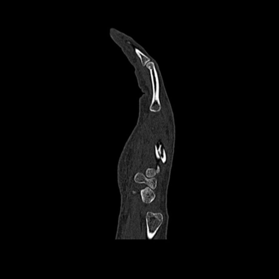 Hand Phantom Metacarpal Fractures for CT Scan & X-Ray Training - Medical Simulation Tool for Radiology Students & Emergency Practice