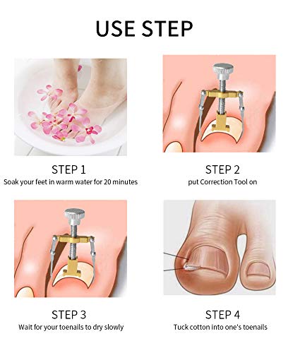 Vitalogy Ingrown Toenail Corrector Tool with Case - Professional Pedicure Corrector, Nail Lifter & Straightener for Ingrown & Fungal Toe Nails | Gold | Perfect for Home Foot Care & Pain Relief
