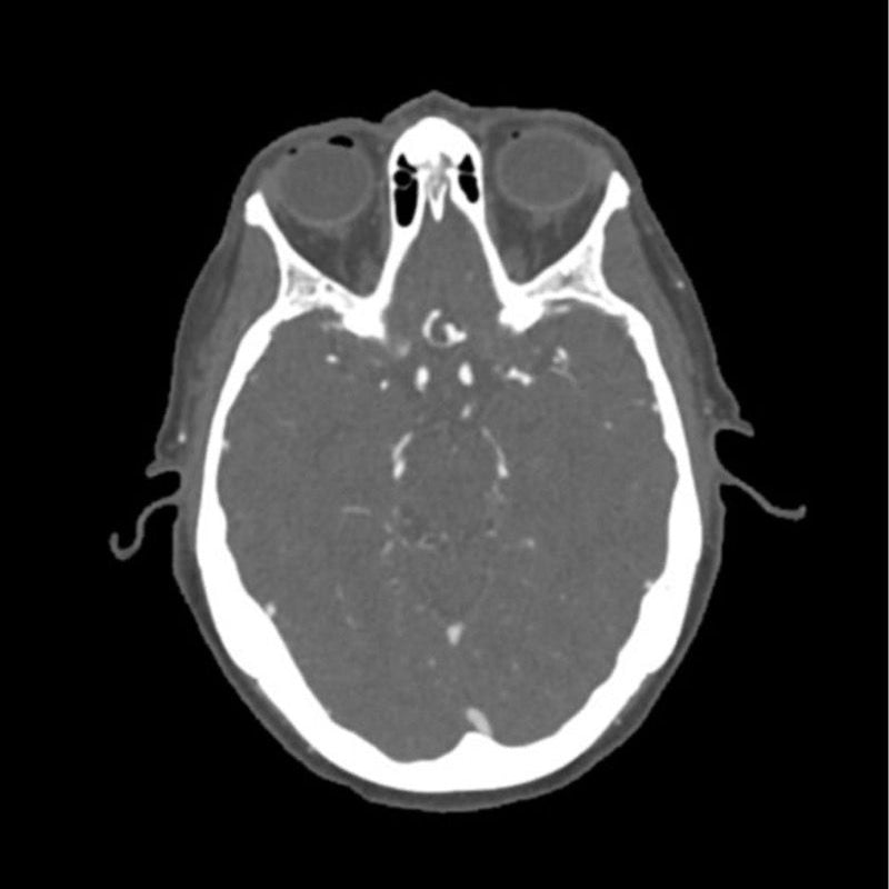 CTA Aneurysm Head Phantom for CT Scan and X-Ray Training - High-Quality Medical Simulation Tool for Radiology Education and Diagnostic Practice