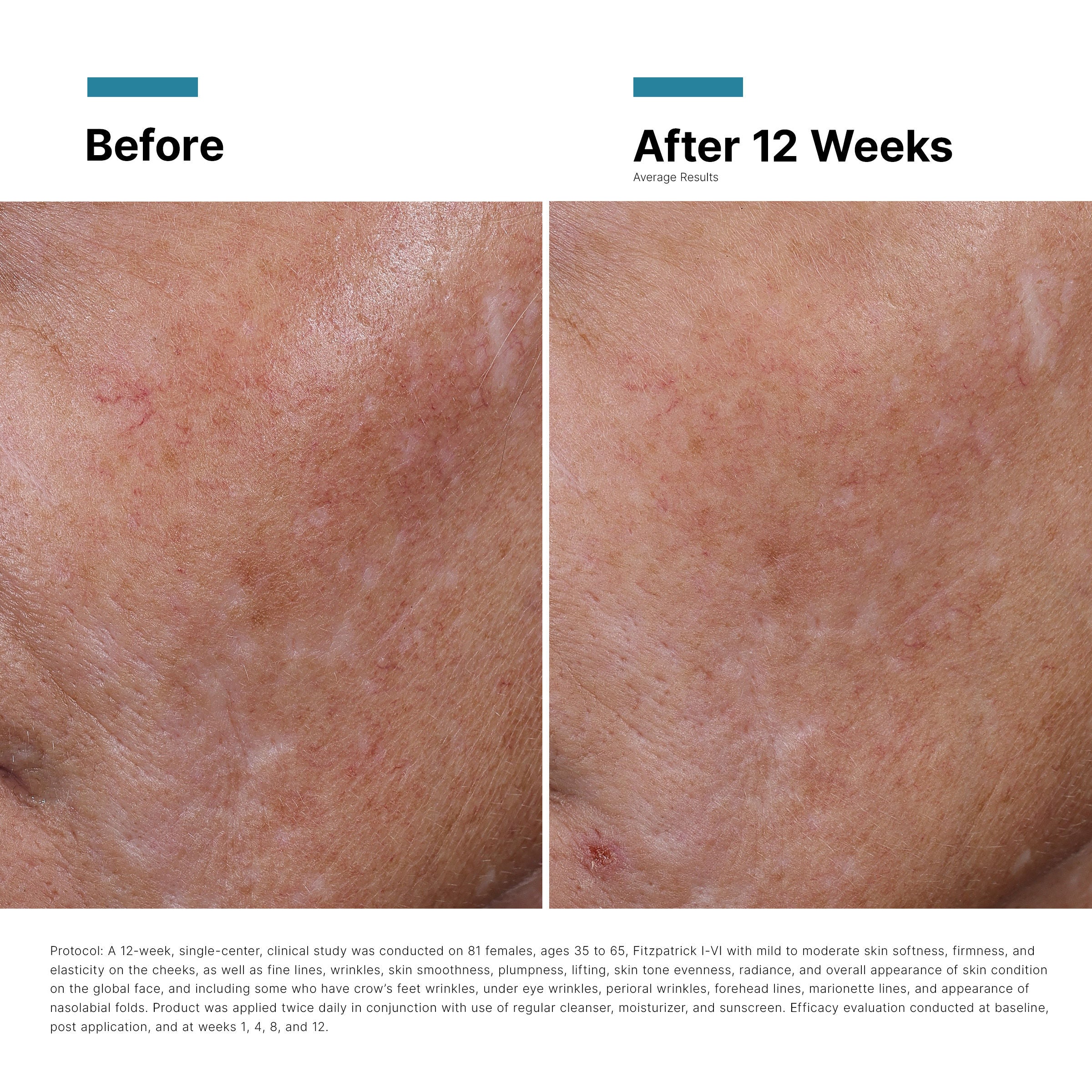 HA Intensifier Multi Glycan Serum - Anti-Aging Hydrating Face Treatment for Wrinkles & Fine Lines | Perfect for Daily Skincare Routine & Nighttime Use