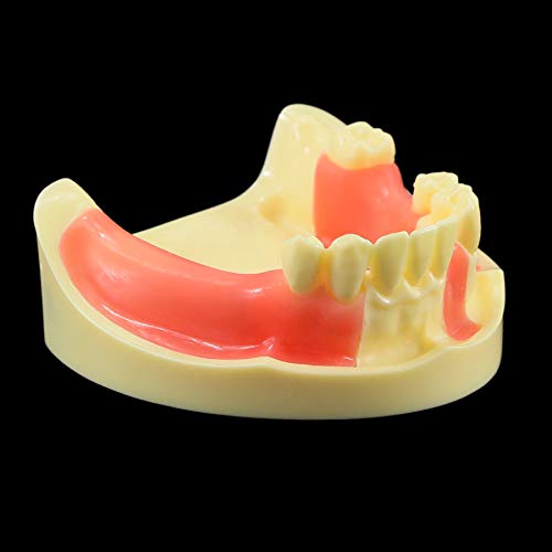 Dental Implant Teeth Model for Demonstration, Practice & Teaching - M2004 (1Pc) | Perfect for Dental Students, Professionals & Training Courses