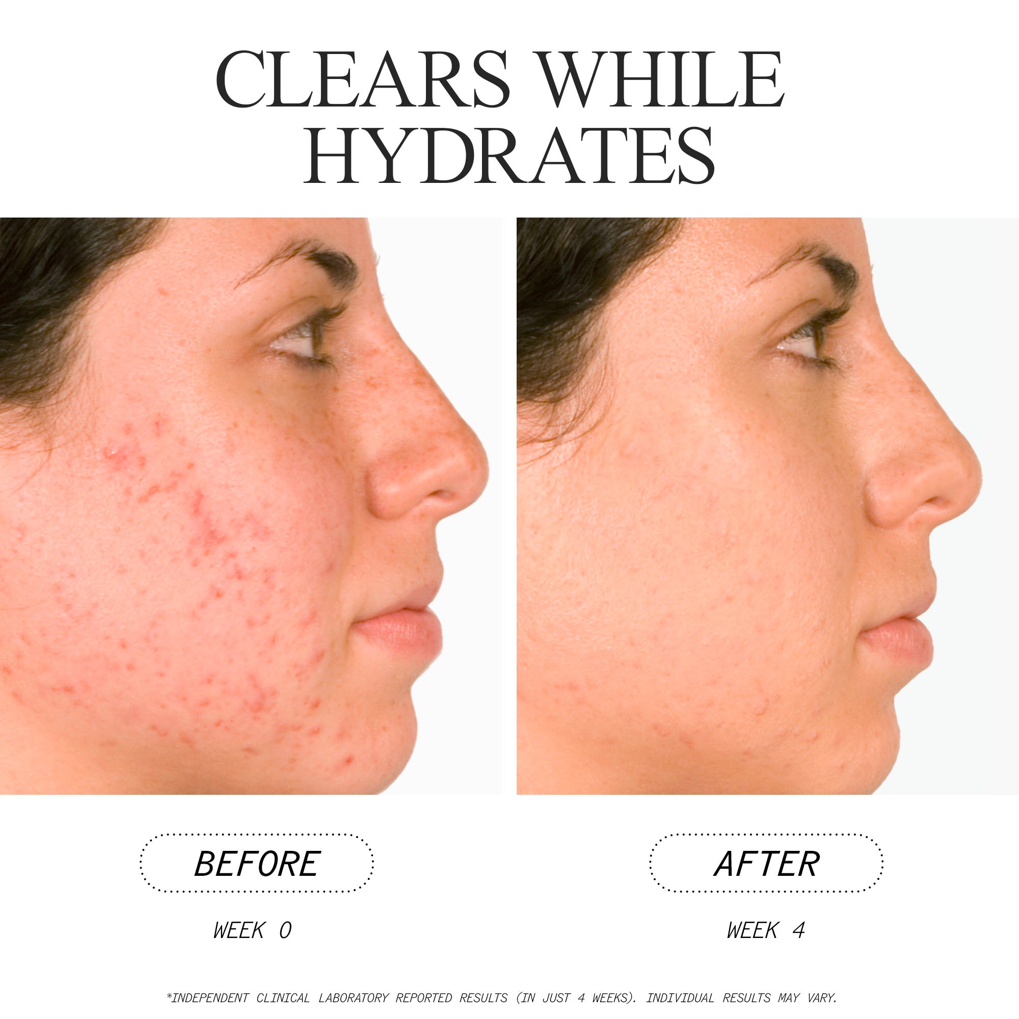 Best Salicylic Acid Acne Serum for Clear Skin - 2% BHA Face Treatment for Acne Prone Skin - Reduces Breakouts & Blackheads - Perfect for Daily Skincare Routine & Oily Skin Care