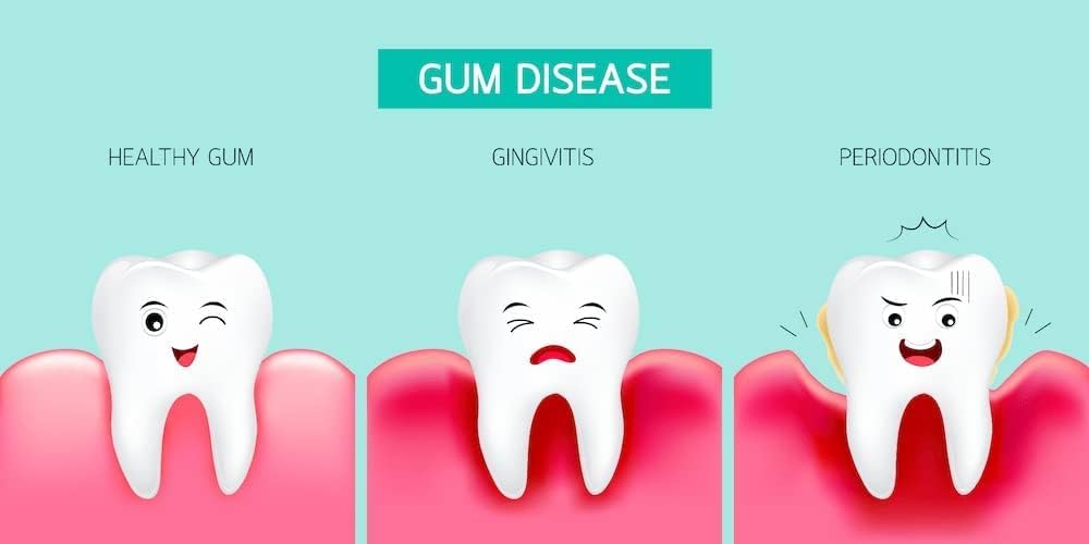 Perio Restore Gel - 3oz Oral Care Treatment with 1.7% Hydrogen Peroxide for Gum Health, Mint Flavor | Freshens Breath & Promotes Healing for Post-Dental Procedures & Daily Oral Hygiene